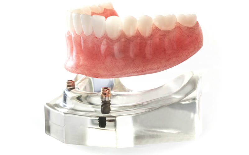 Partial dentures