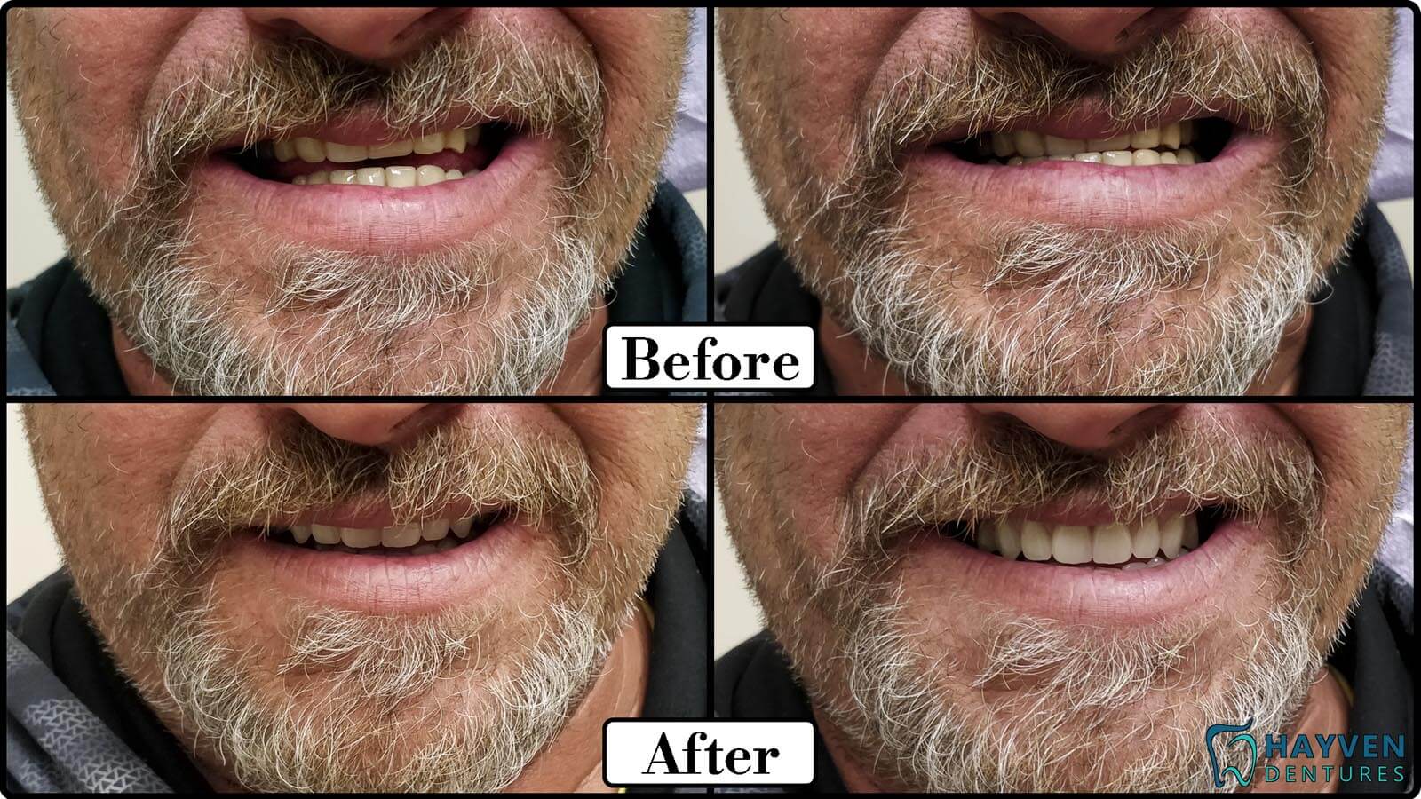 Before: Patient's teeth with visible problems. After: Patient with their new dentures.