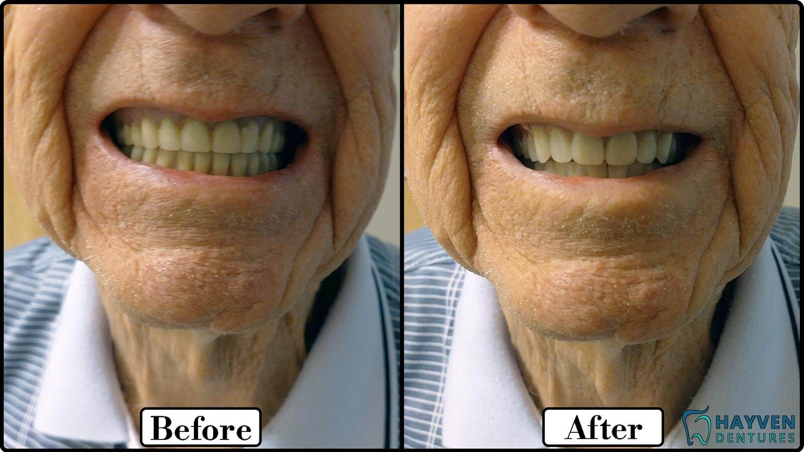 Before: Patient's teeth with visible problems. After: Patient with their new dentures.