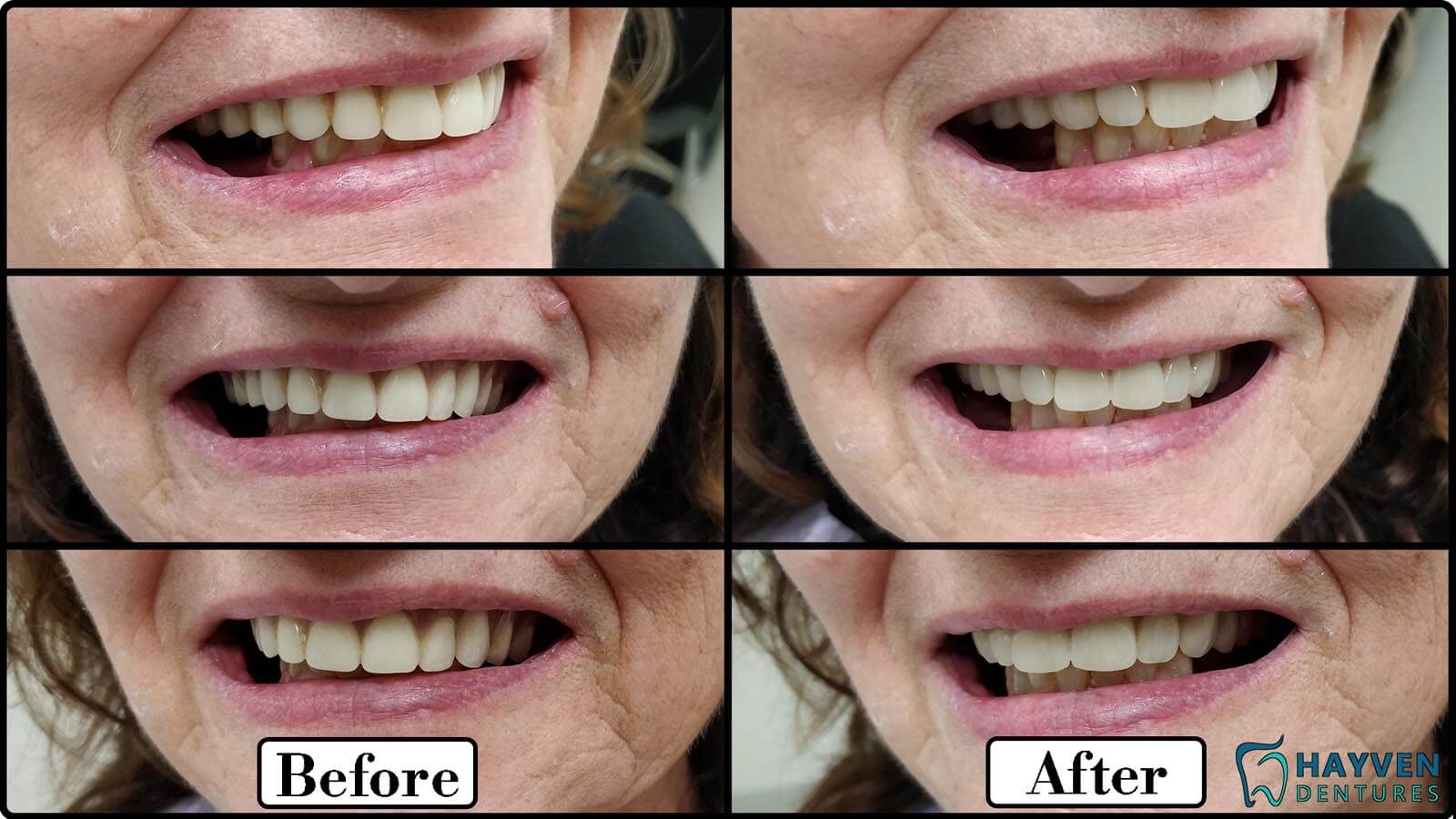 Before: Patient's teeth with visible problems. After: Patient with their new dentures.