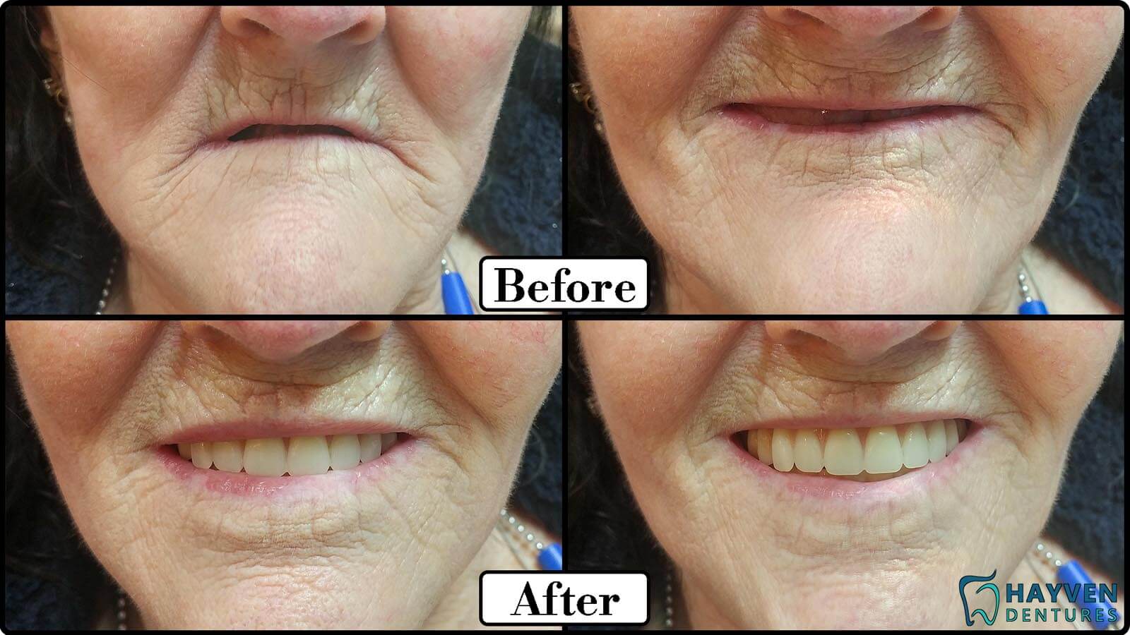 Before: Patient's teeth with visible problems. After: Patient with their new dentures.