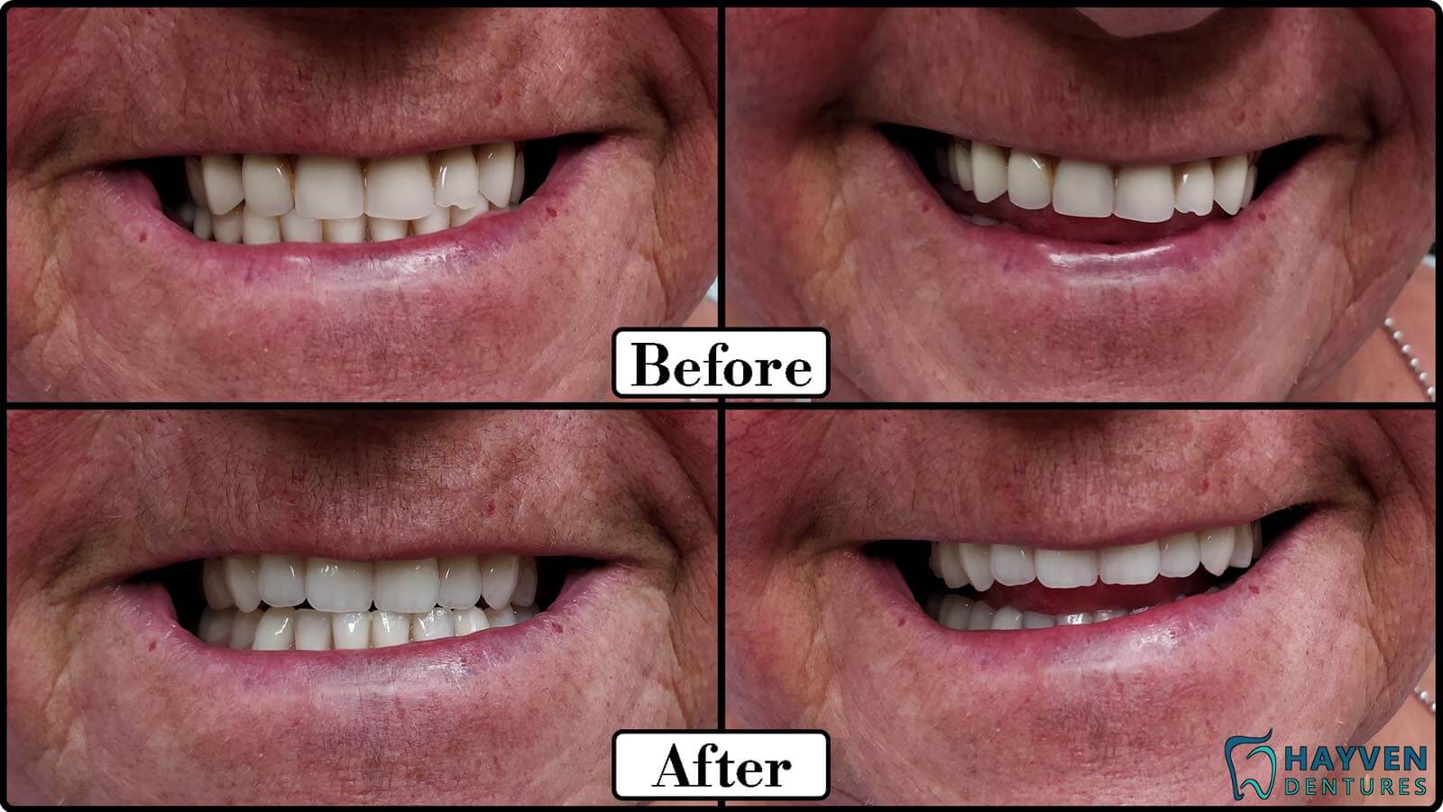 Before: Patient's teeth with visible problems. After: Patient with their new dentures.