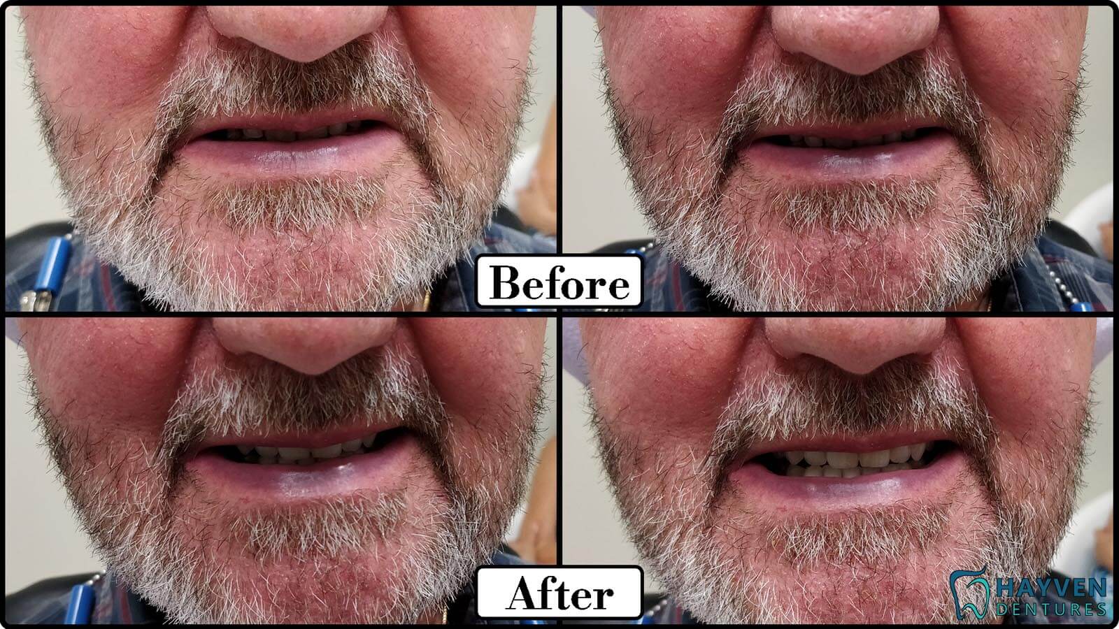 Before: Patient's teeth with visible problems. After: Patient with their new dentures.