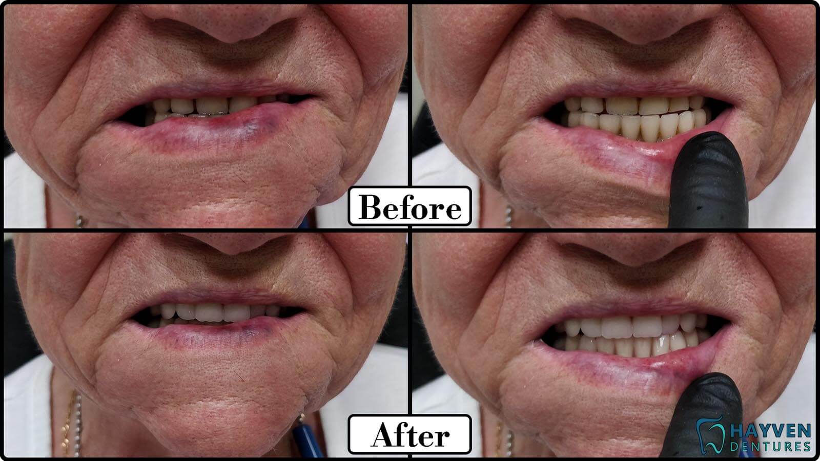 Before: Patient's teeth with visible problems. After: Patient with their new dentures.