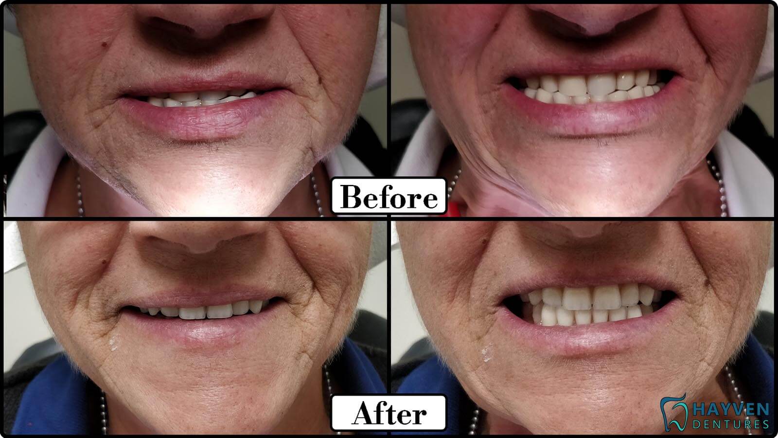 Before: Patient's teeth with visible problems. After: Patient with their new dentures.