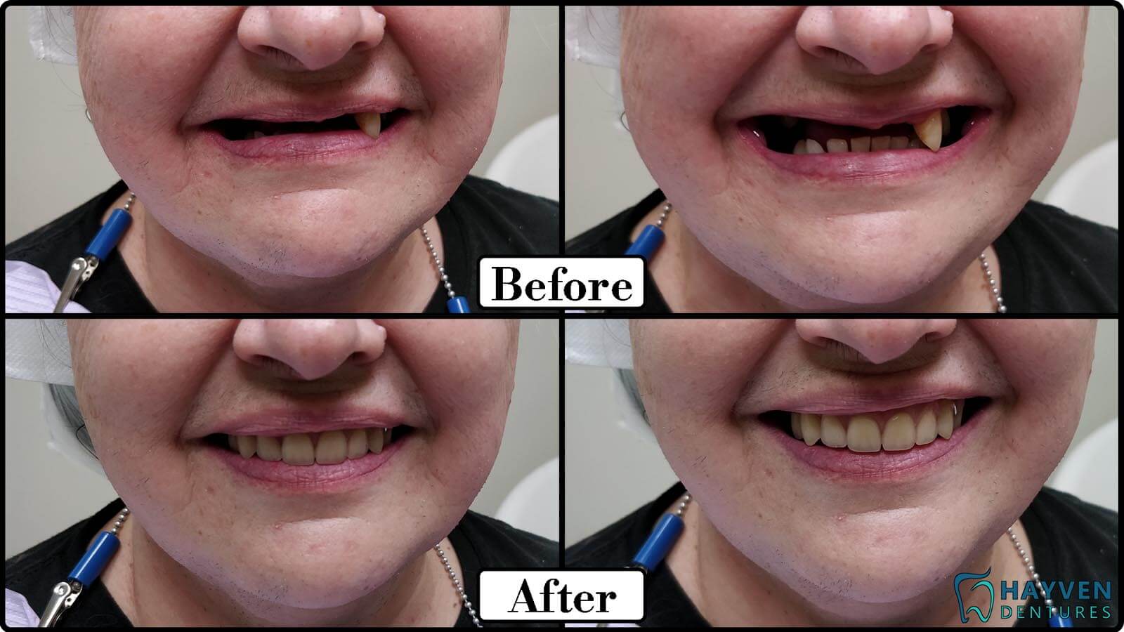 Before: Patient's teeth with visible problems. After: Patient with their new dentures.