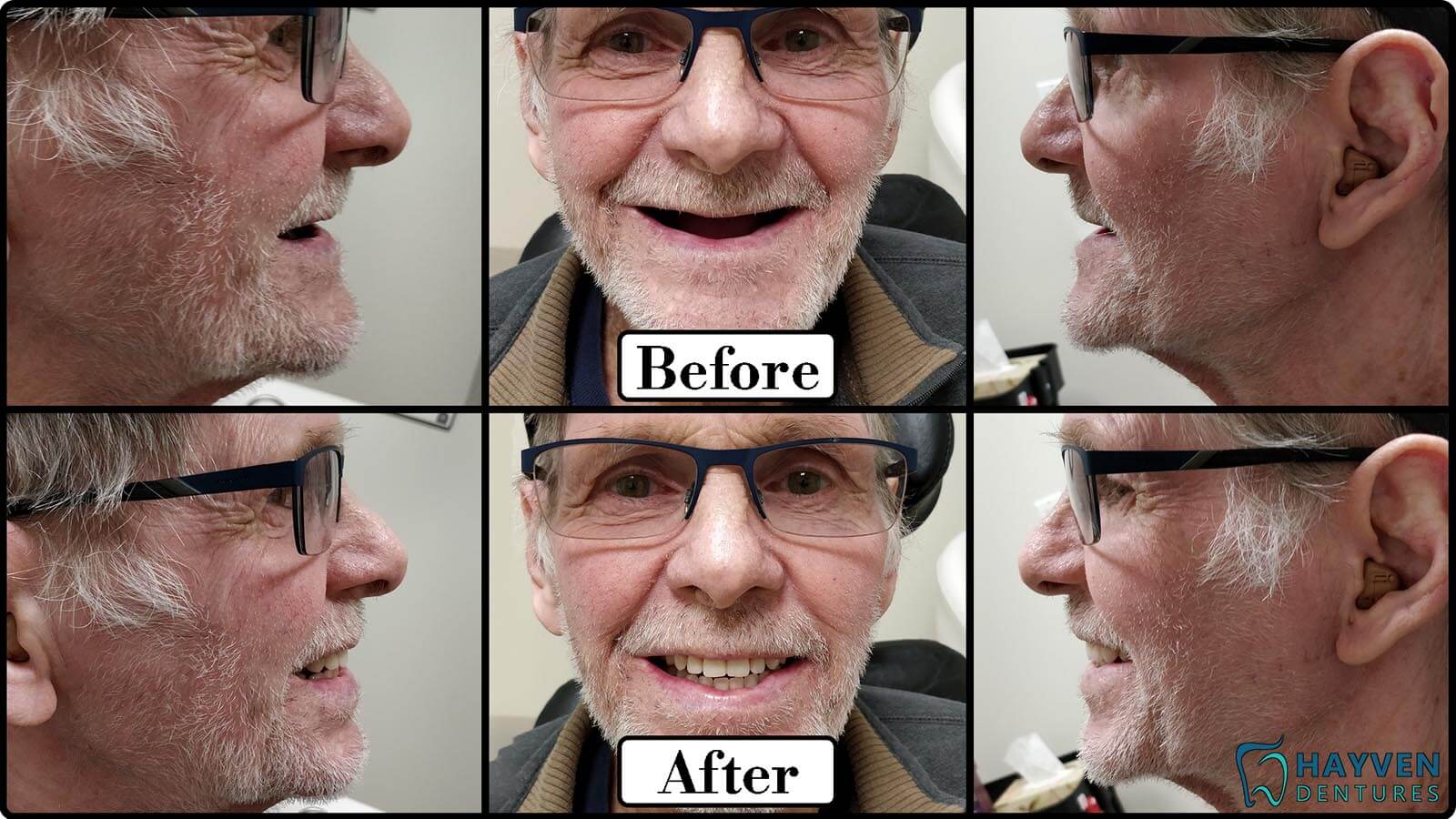 Before: Patient's teeth with visible problems. After: Patient with their new dentures.