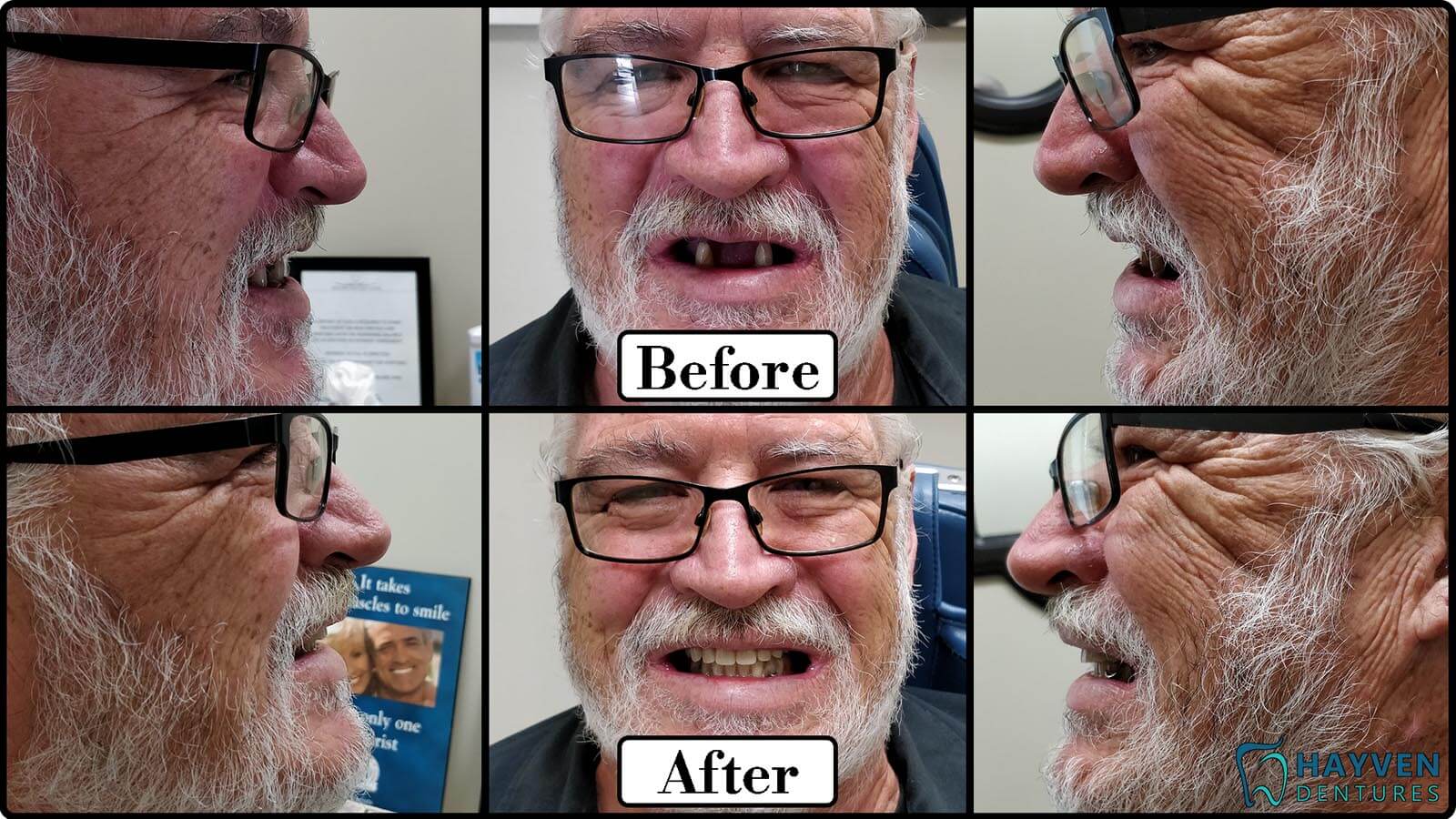 Before: Patient's teeth with visible problems. After: Patient with their new dentures.