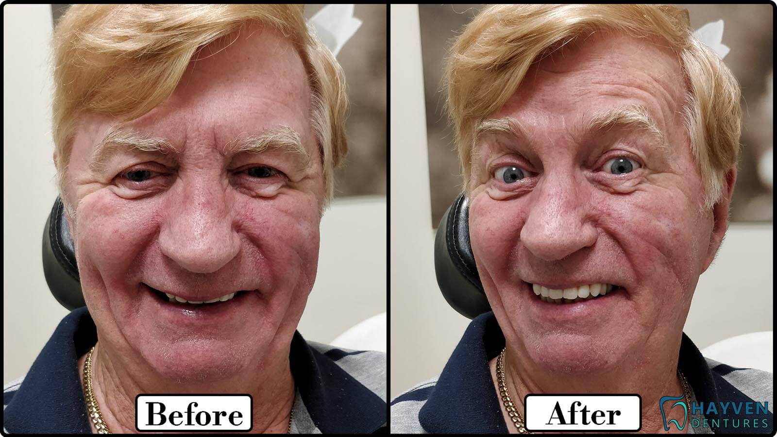 Before: Patient's teeth with visible problems. After: Patient with their new dentures.