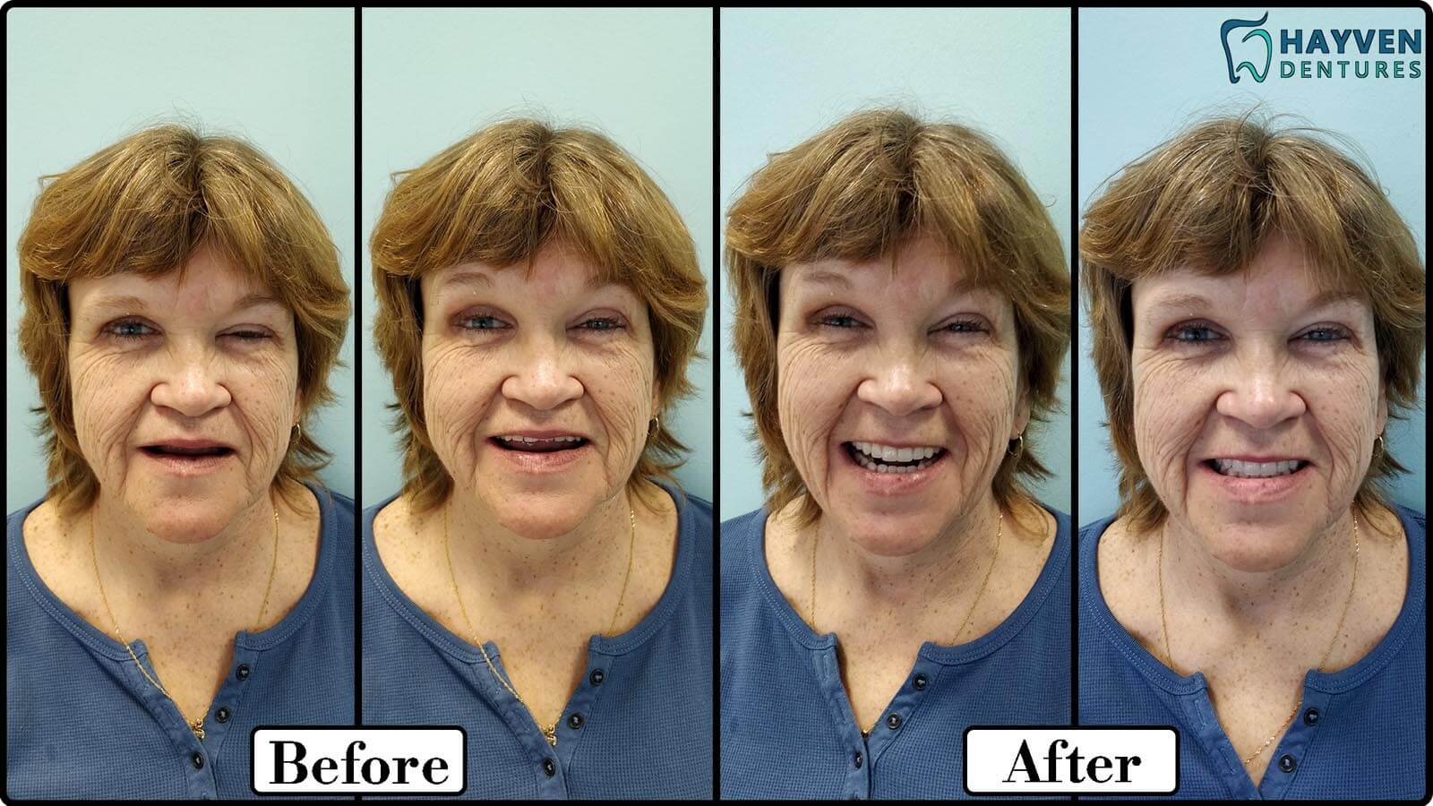 Before: Patient's teeth with visible problems. After: Patient with their new dentures.