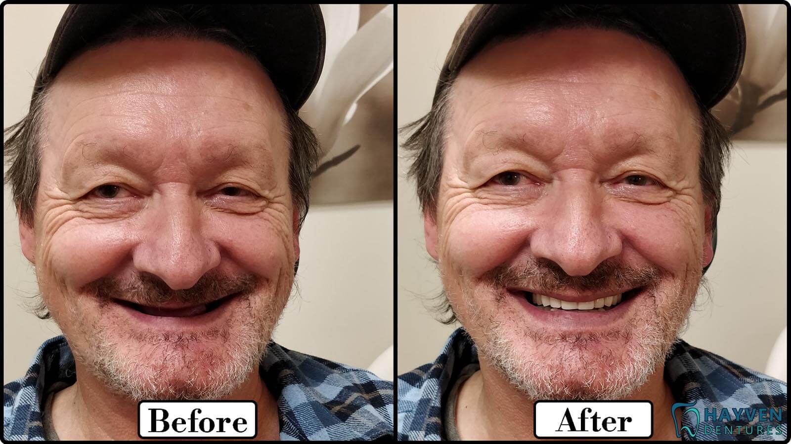 Before: Patient's teeth with visible problems. After: Patient with their new dentures.