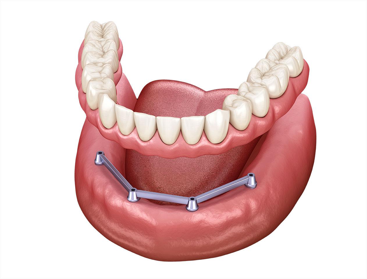 implant bar retained dentures