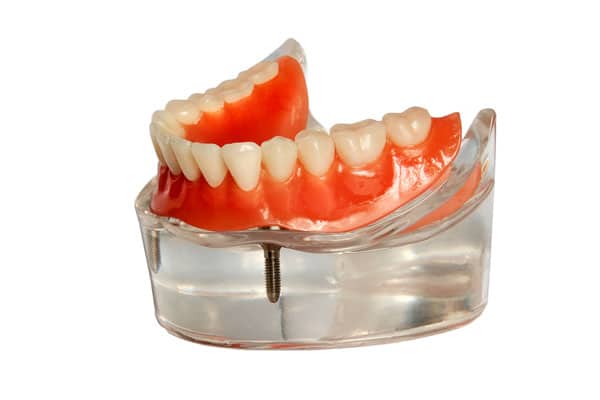 Implant dentures