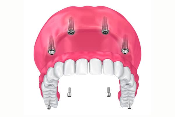 Implant retained dentures