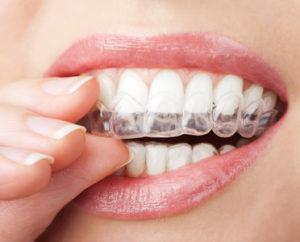 woman removing her invisalign braces