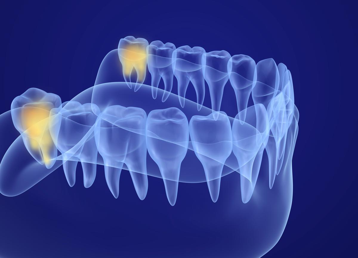 a stock photo showing wisdom teeth placement