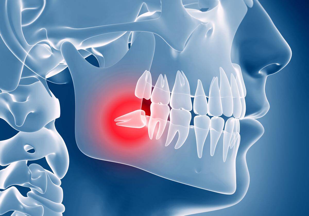 a stock photo showing a wisdom tooth that is coming in at a bad angle causing pain