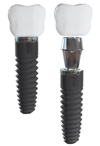 picture of a dental implant
