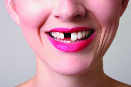 stock photo of a woman missing a tooth