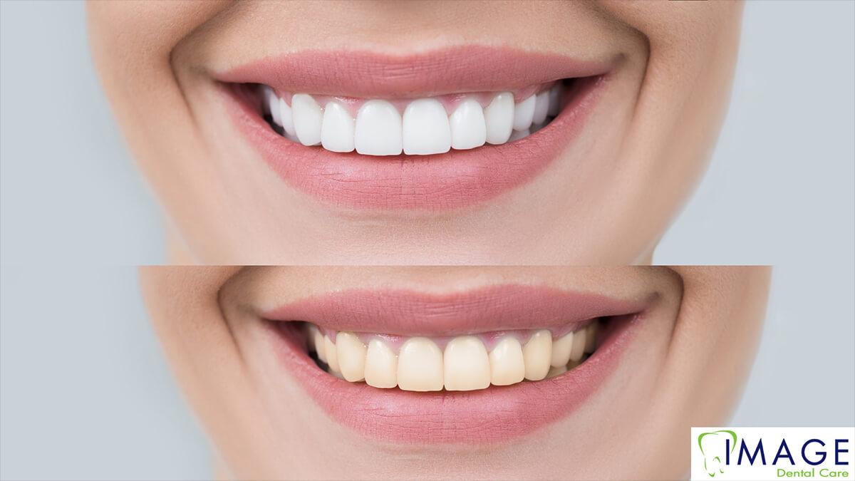 Before and after whitening shots.