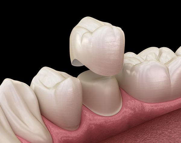 dental crown lengthening at kitchener dental office