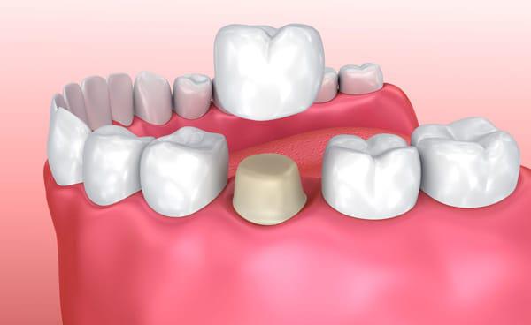 dental crowns in kitchener