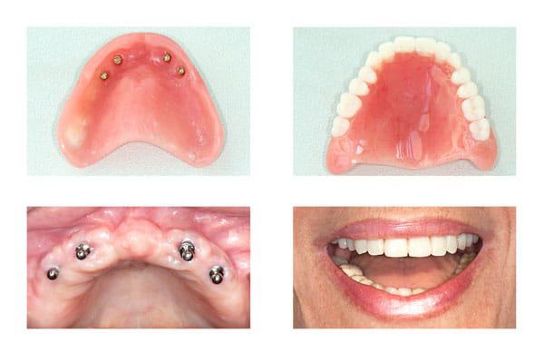 Gums with fitted with implants (left). And with new dentures (right).