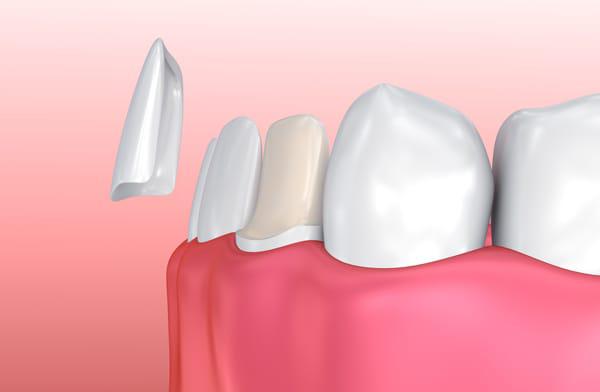 dental veneers in kitchener