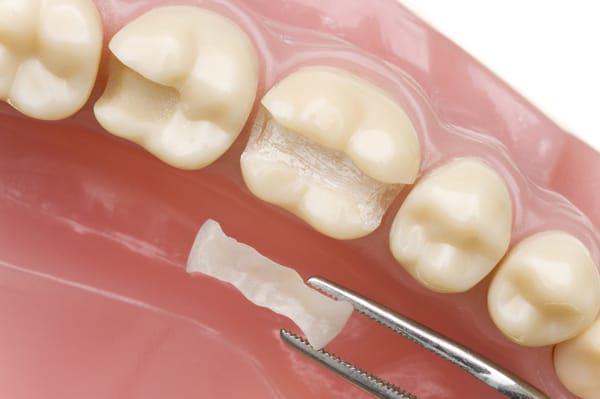 dental onlay in kitchener
