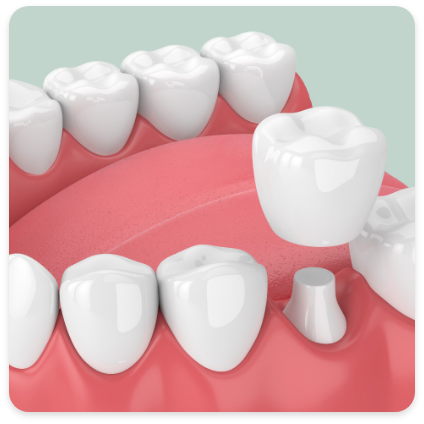 Dental Crowns