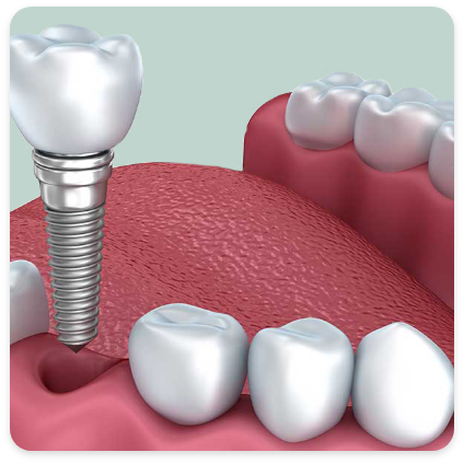 Dental Implants