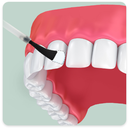 Fluoride treatment