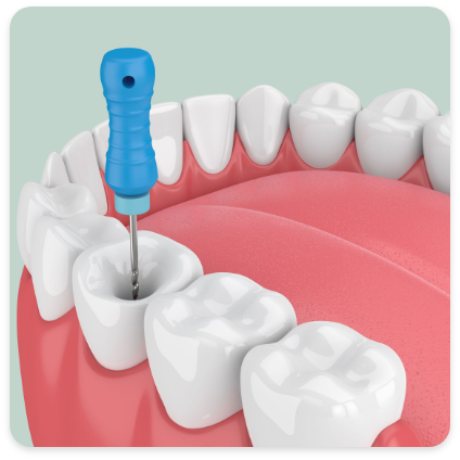 Root canal treatments