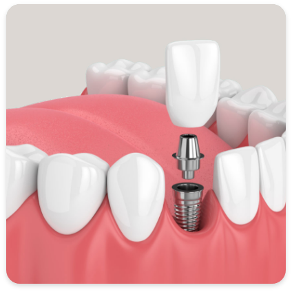 Dental Implants