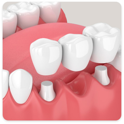 Dental Bridges