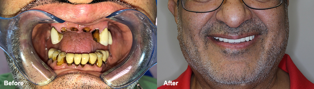 Before: Patient missing 4 front teet and showing lots of tooth decay. After: Perfect smile!