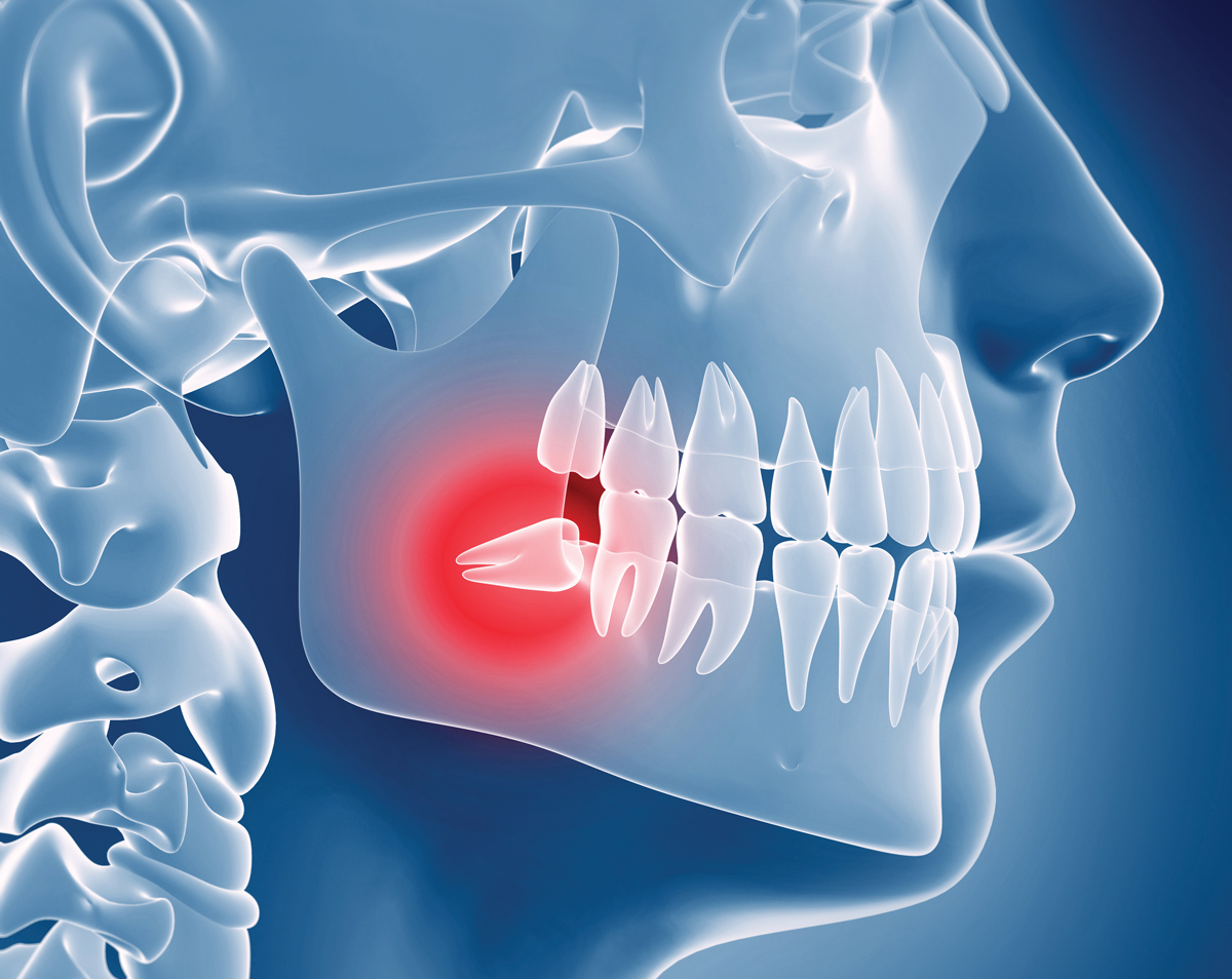 A diagram of wisdom teeth growing growing adjacent teeth.