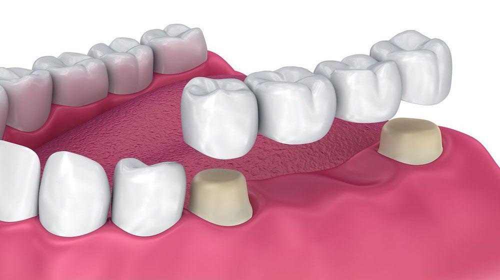 A diagram of a dental bridge.