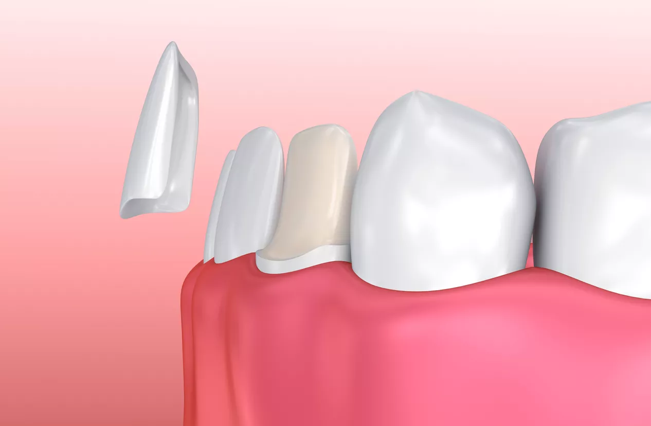 A diagram of porcelain veneers being fitted over teeth.