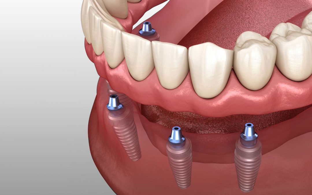 A diagram of implant retained dentures.