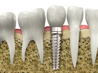 Tooth implants