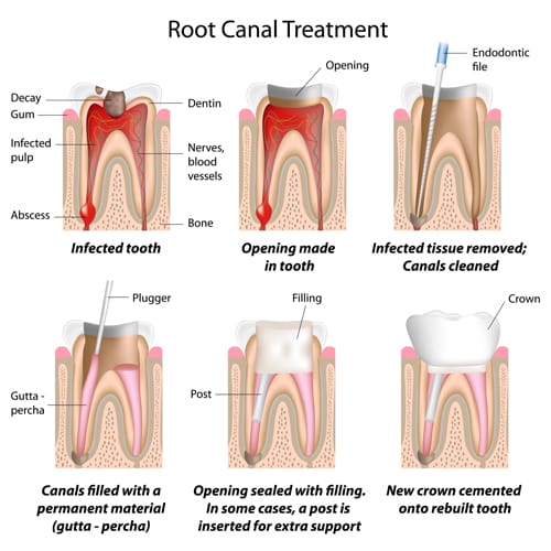 A root canal diagram showing infected tissue removal, followed by filling and a crown.