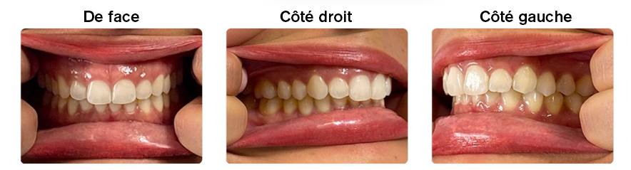 Photos de vos dents de face, du côté droit et du côté gauche