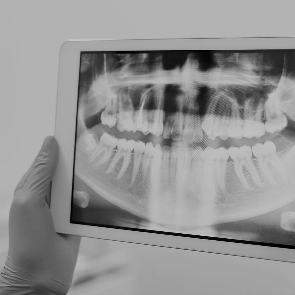 Tooth x-ray