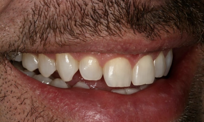 Teeth appear worn and discoloured.