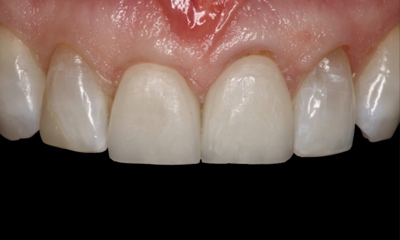 Teeth appear worn and discoloured with gum recession.