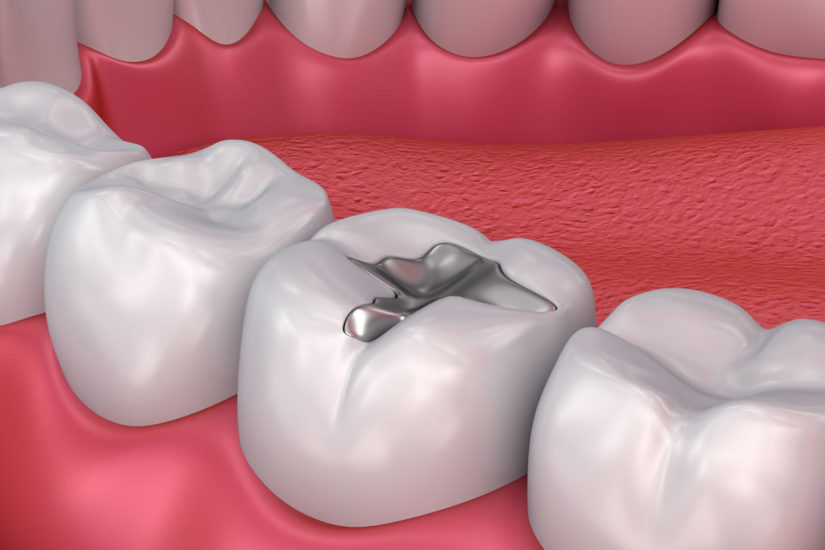 A diagram of Silver Mercury Fillings