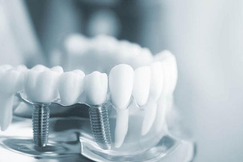 A cross section graphic showing how dental implants are fitted into the jaw.