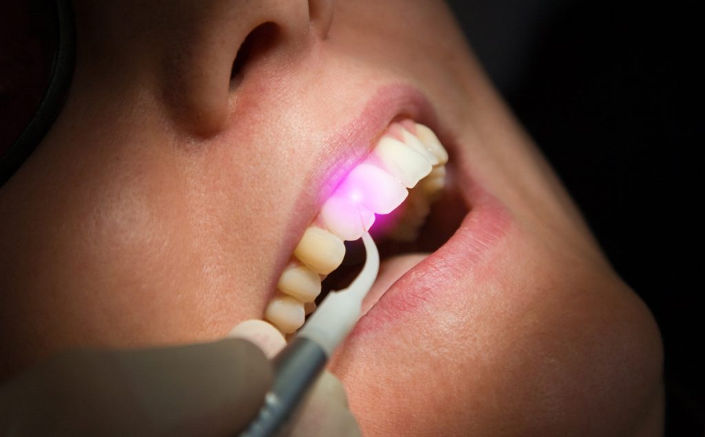 Teeth brace on plate