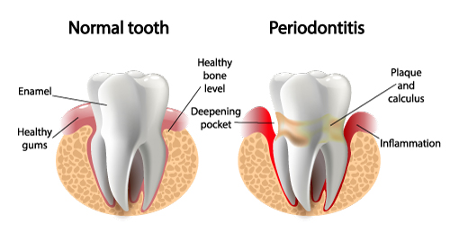 A diagram showing inflammation, plaque and deepening pocket on a tooth with Peridontitis.